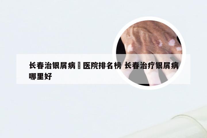 长春治银屑病旳医院排名榜 长春治疗银屑病哪里好