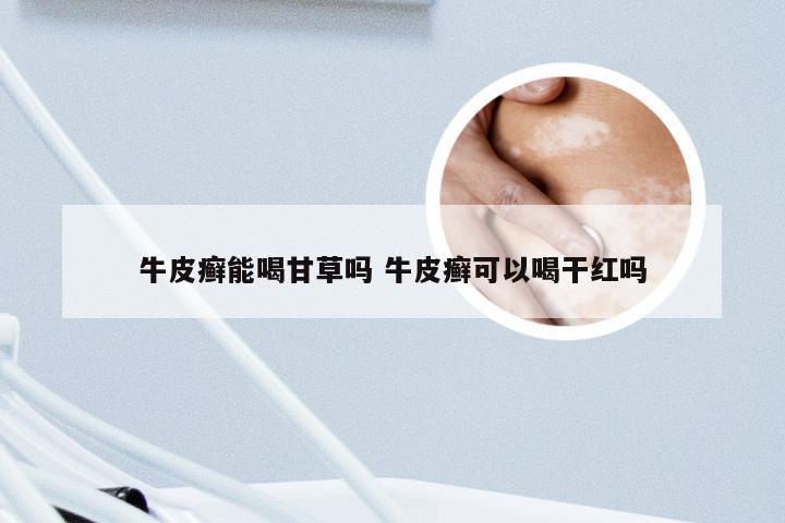 牛皮癣能喝甘草吗 牛皮癣可以喝干红吗