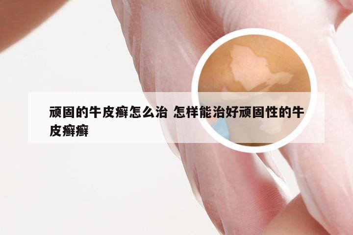 顽固的牛皮癣怎么治 怎样能治好顽固性的牛皮癣癣