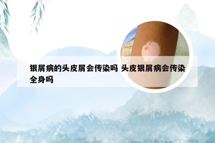 银屑病的头皮屑会传染吗 头皮银屑病会传染全身吗