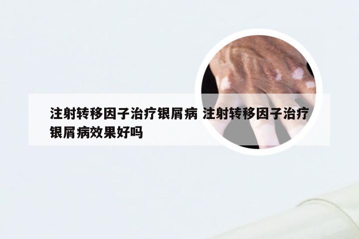 注射转移因子治疗银屑病 注射转移因子治疗银屑病效果好吗