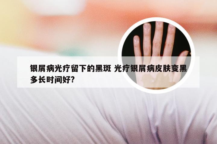 银屑病光疗留下的黑斑 光疗银屑病皮肤变黑多长时间好?