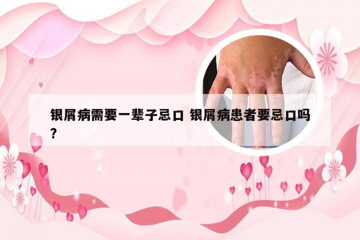 银屑病需要一辈子忌口 银屑病患者要忌口吗?