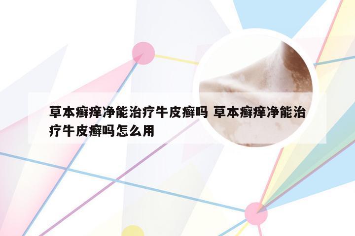 草本癣痒净能治疗牛皮癣吗 草本癣痒净能治疗牛皮癣吗怎么用