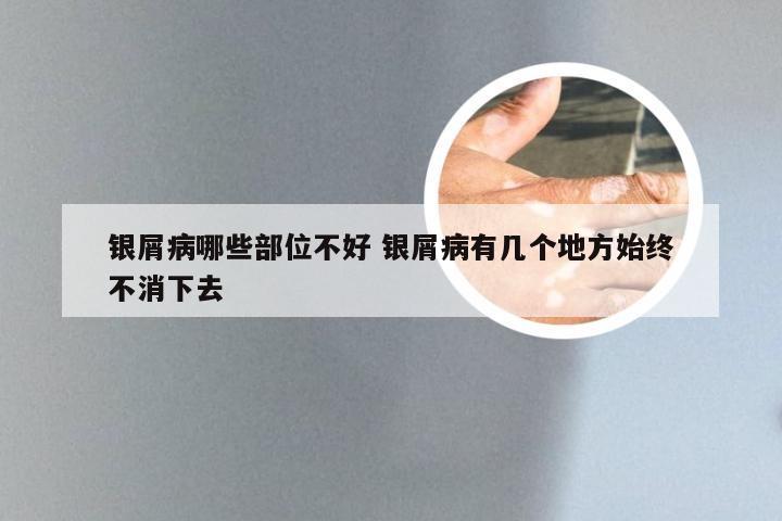 银屑病哪些部位不好 银屑病有几个地方始终不消下去