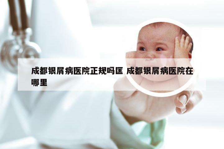 成都银屑病医院正规吗匡 成都银屑病医院在哪里