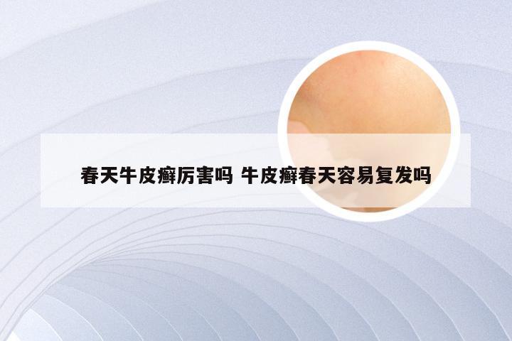 春天牛皮癣厉害吗 牛皮癣春天容易复发吗