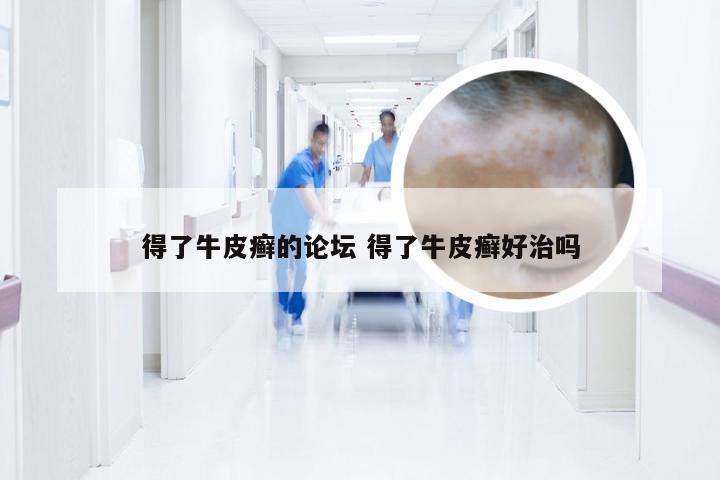 得了牛皮癣的论坛 得了牛皮癣好治吗
