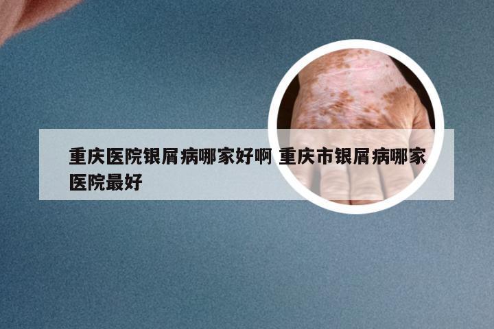 重庆医院银屑病哪家好啊 重庆市银屑病哪家医院最好