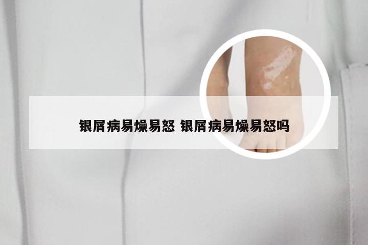 银屑病易燥易怒 银屑病易燥易怒吗