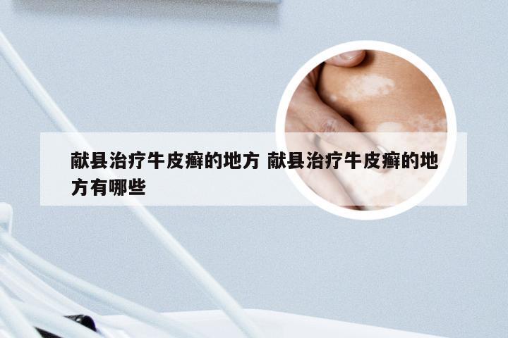 献县治疗牛皮癣的地方 献县治疗牛皮癣的地方有哪些