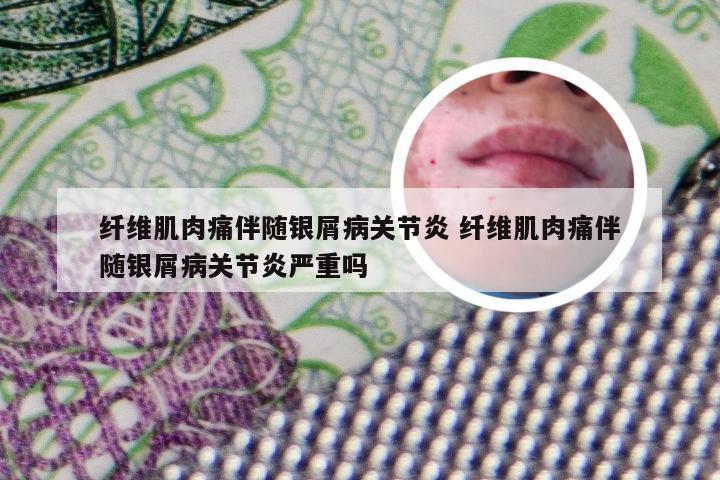 纤维肌肉痛伴随银屑病关节炎 纤维肌肉痛伴随银屑病关节炎严重吗