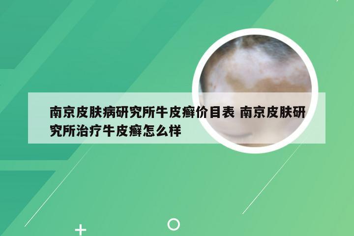 南京皮肤病研究所牛皮癣价目表 南京皮肤研究所治疗牛皮癣怎么样
