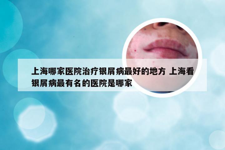 上海哪家医院治疗银屑病最好的地方 上海看银屑病最有名的医院是哪家