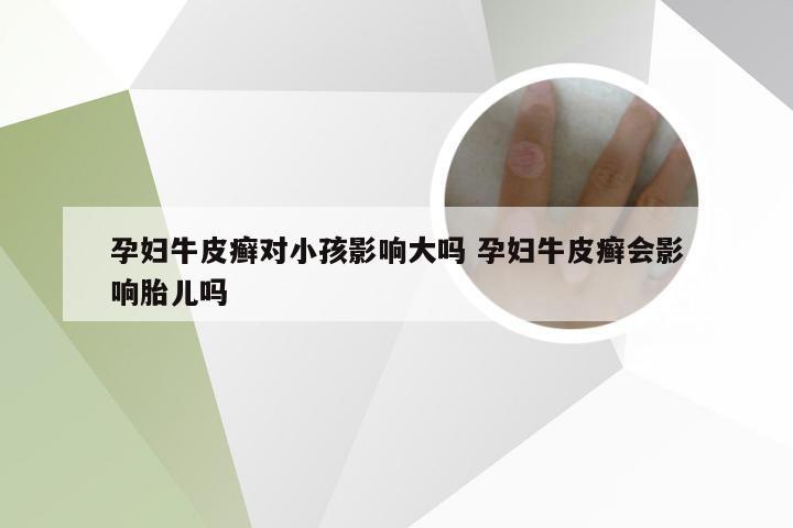 孕妇牛皮癣对小孩影响大吗 孕妇牛皮癣会影响胎儿吗