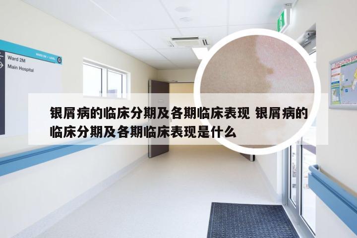 银屑病的临床分期及各期临床表现 银屑病的临床分期及各期临床表现是什么