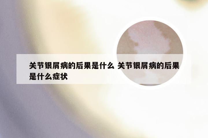 关节银屑病的后果是什么 关节银屑病的后果是什么症状