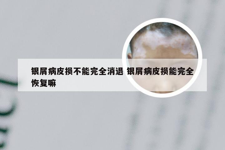 银屑病皮损不能完全消退 银屑病皮损能完全恢复嘛