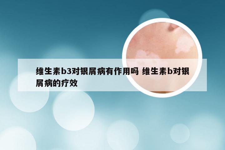 维生素b3对银屑病有作用吗 维生素b对银屑病的疗效