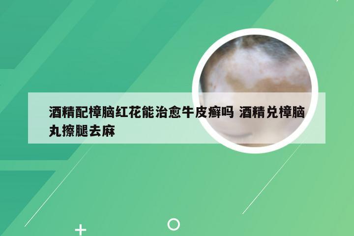 酒精配樟脑红花能治愈牛皮癣吗 酒精兑樟脑丸擦腿去麻