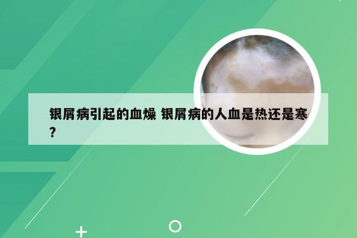 银屑病引起的血燥 银屑病的人血是热还是寒?