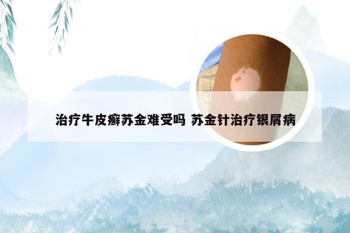 治疗牛皮癣苏金难受吗 苏金针治疗银屑病
