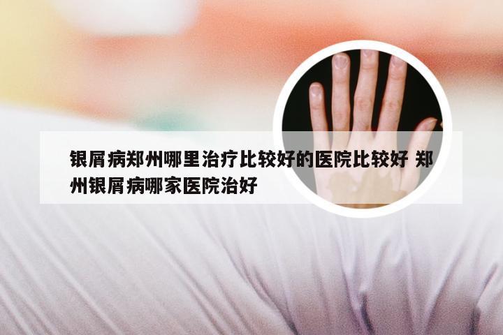 银屑病郑州哪里治疗比较好的医院比较好 郑州银屑病哪家医院治好