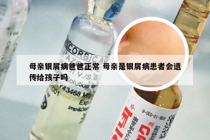 母亲银屑病爸爸正常 母亲是银屑病患者会遗传给孩子吗