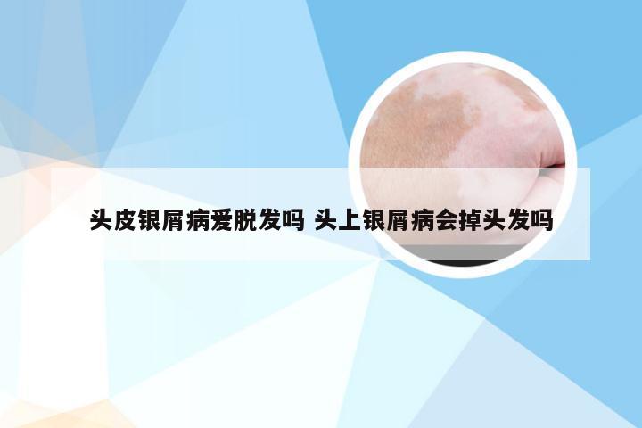 头皮银屑病爱脱发吗 头上银屑病会掉头发吗