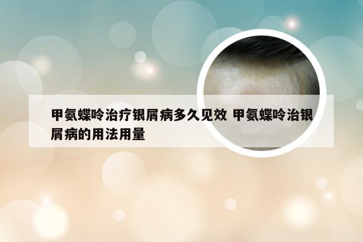 甲氨蝶呤治疗银屑病多久见效 甲氨蝶呤治银屑病的用法用量