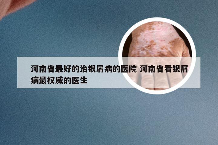 河南省最好的治银屑病的医院 河南省看银屑病最权威的医生