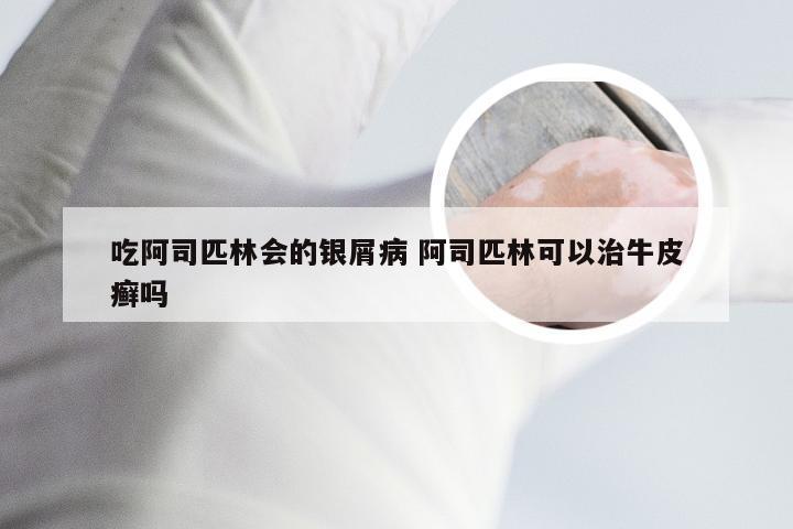 吃阿司匹林会的银屑病 阿司匹林可以治牛皮癣吗