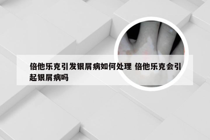 倍他乐克引发银屑病如何处理 倍他乐克会引起银屑病吗