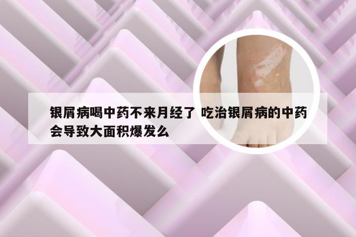 银屑病喝中药不来月经了 吃治银屑病的中药会导致大面积爆发么