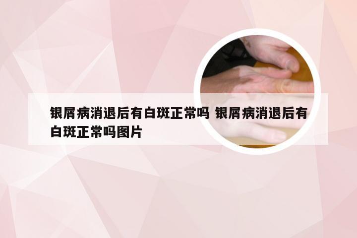 银屑病消退后有白斑正常吗 银屑病消退后有白斑正常吗图片