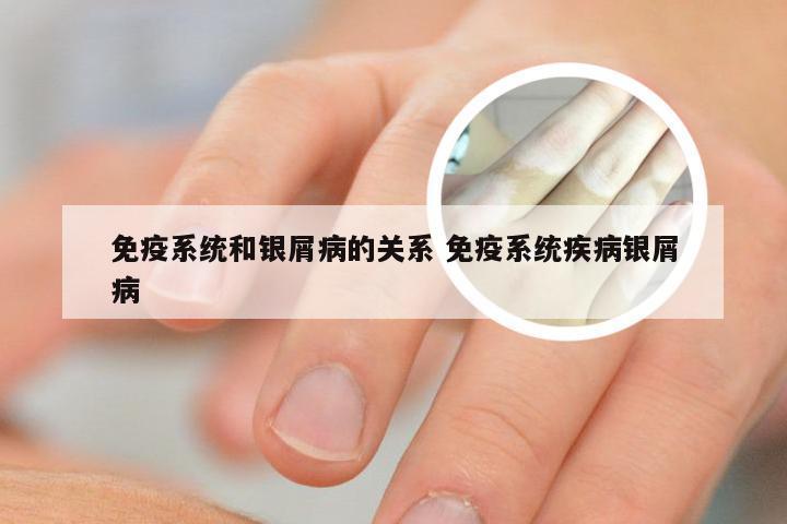 免疫系统和银屑病的关系 免疫系统疾病银屑病