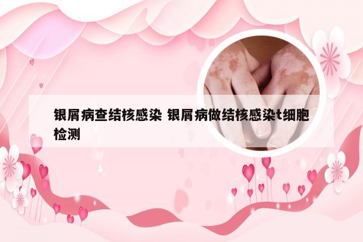 银屑病查结核感染 银屑病做结核感染t细胞检测