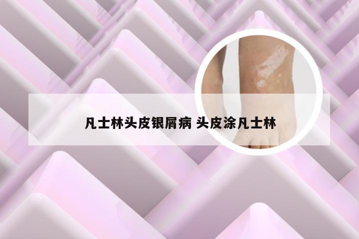 凡士林头皮银屑病 头皮涂凡士林