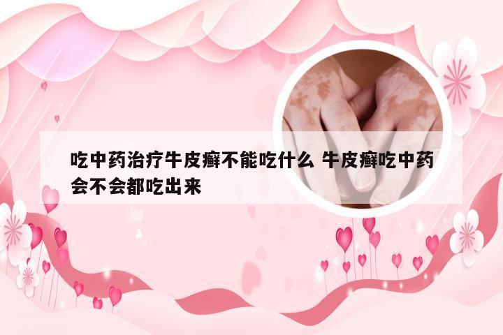 吃中药治疗牛皮癣不能吃什么 牛皮癣吃中药会不会都吃出来