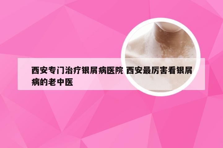 西安专门治疗银屑病医院 西安最厉害看银屑病的老中医