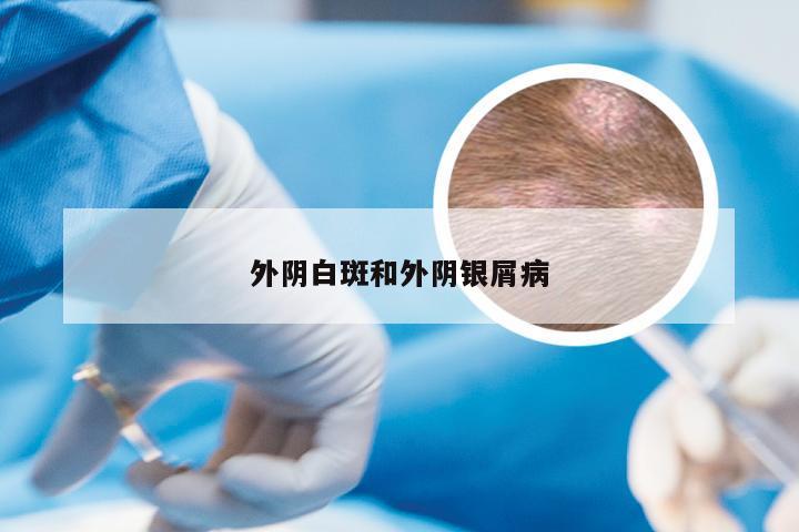 外阴白斑和外阴银屑病