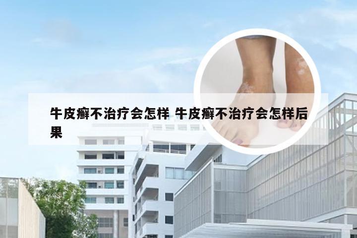 牛皮癣不治疗会怎样 牛皮癣不治疗会怎样后果