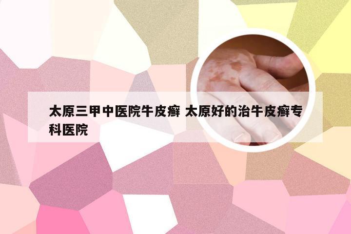 太原三甲中医院牛皮癣 太原好的治牛皮癣专科医院