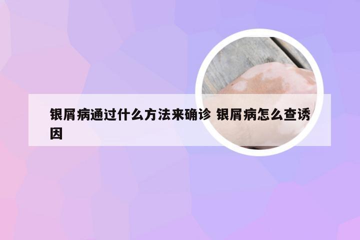 银屑病通过什么方法来确诊 银屑病怎么查诱因