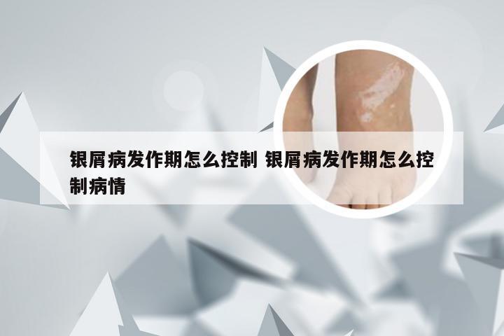 银屑病发作期怎么控制 银屑病发作期怎么控制病情