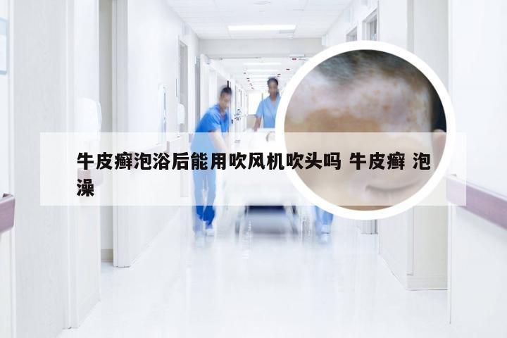 牛皮癣泡浴后能用吹风机吹头吗 牛皮癣 泡澡