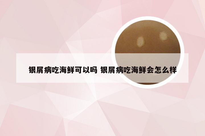 银屑病吃海鲜可以吗 银屑病吃海鲜会怎么样
