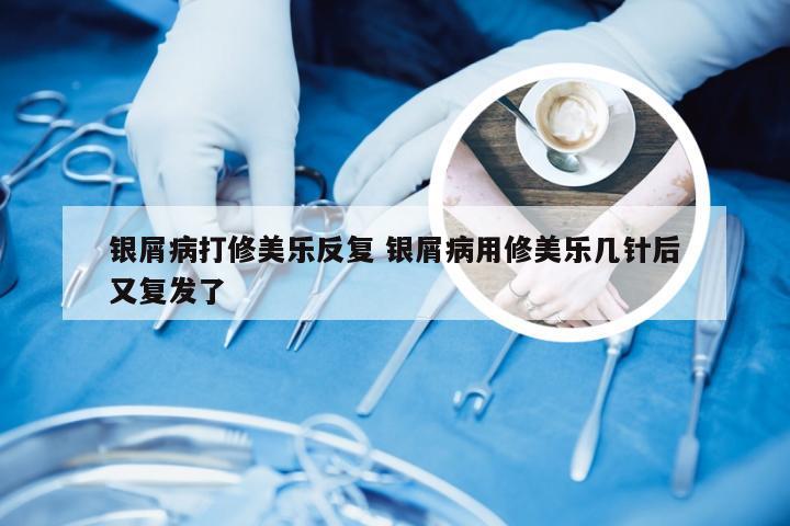 银屑病打修美乐反复 银屑病用修美乐几针后又复发了