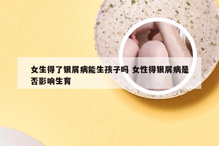 女生得了银屑病能生孩子吗 女性得银屑病是否影响生育