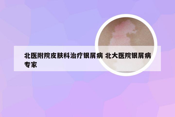 北医附院皮肤科治疗银屑病 北大医院银屑病专家